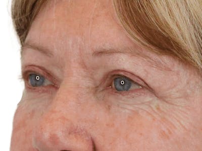 Blepharoplasty Before & After Gallery - Patient 162339203 - Image 4