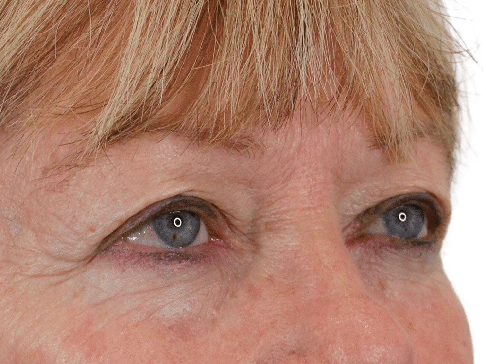 Blepharoplasty Before & After Gallery - Patient 162339203 - Image 5