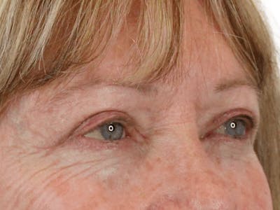 Blepharoplasty Before & After Gallery - Patient 162339203 - Image 6