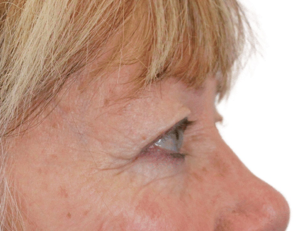 Blepharoplasty Before & After Gallery - Patient 162339203 - Image 7