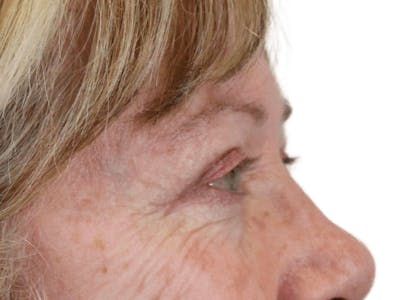 Blepharoplasty Before & After Gallery - Patient 162339203 - Image 8