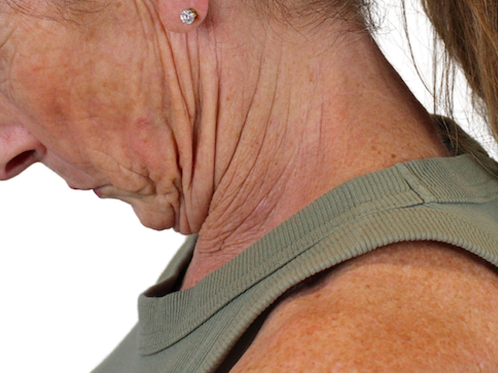 Deep Neck Lift Before & After Gallery - Patient 148519137 - Image 7