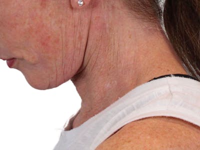 Deep Neck Lift Before & After Gallery - Patient 148519137 - Image 8