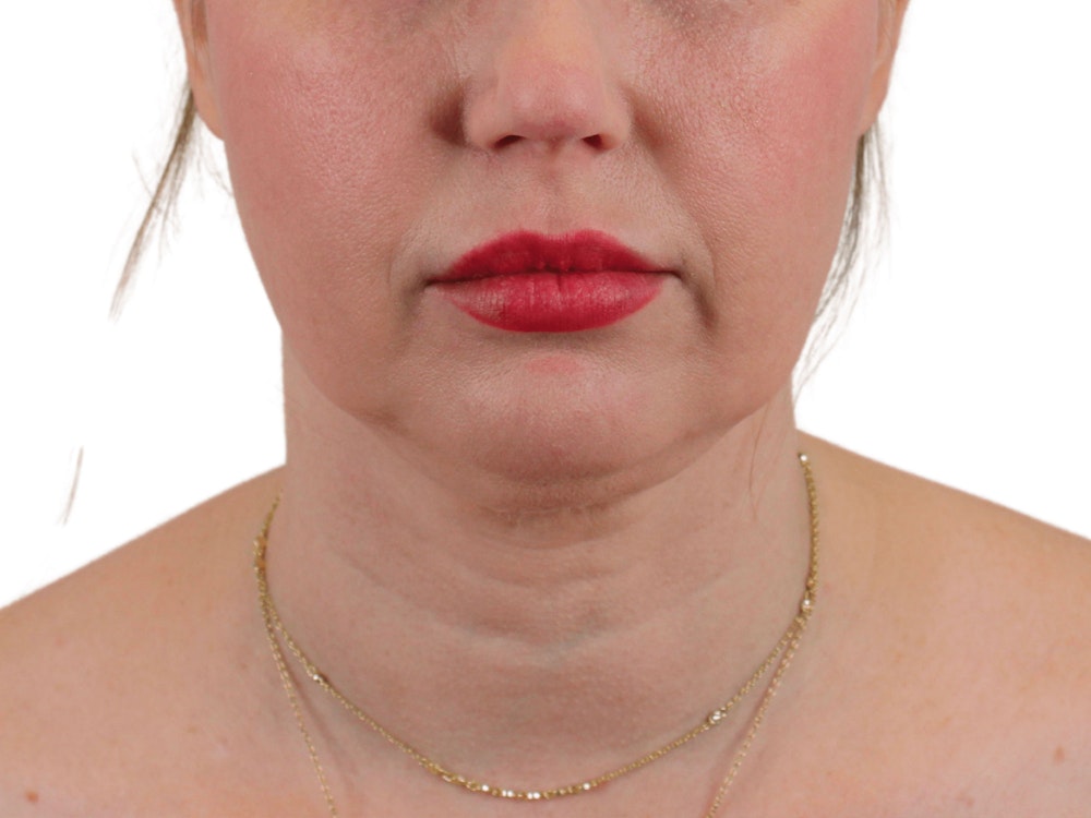 Deep Neck Lift Before & After Gallery - Patient 148352221 - Image 1