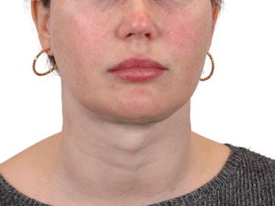Deep Neck Lift Before & After Gallery - Patient 148352221 - Image 2