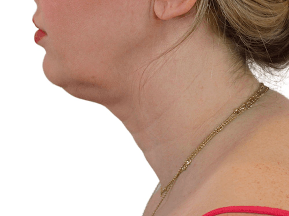 Deep Neck Lift Before & After Gallery - Patient 148352221 - Image 3