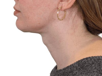 Deep Neck Lift Before & After Gallery - Patient 148352221 - Image 4