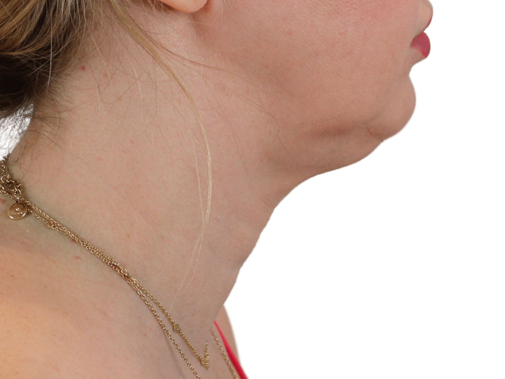 Deep Neck Lift Before & After Gallery - Patient 148352221 - Image 5