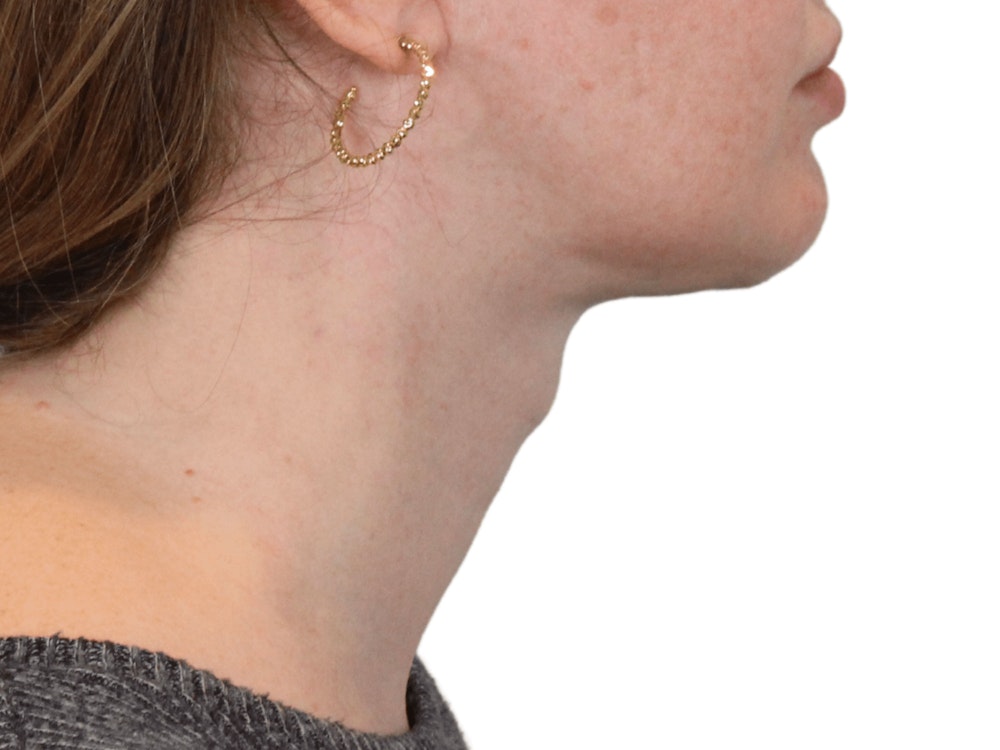 Deep Neck Lift Before & After Gallery - Patient 148352221 - Image 6
