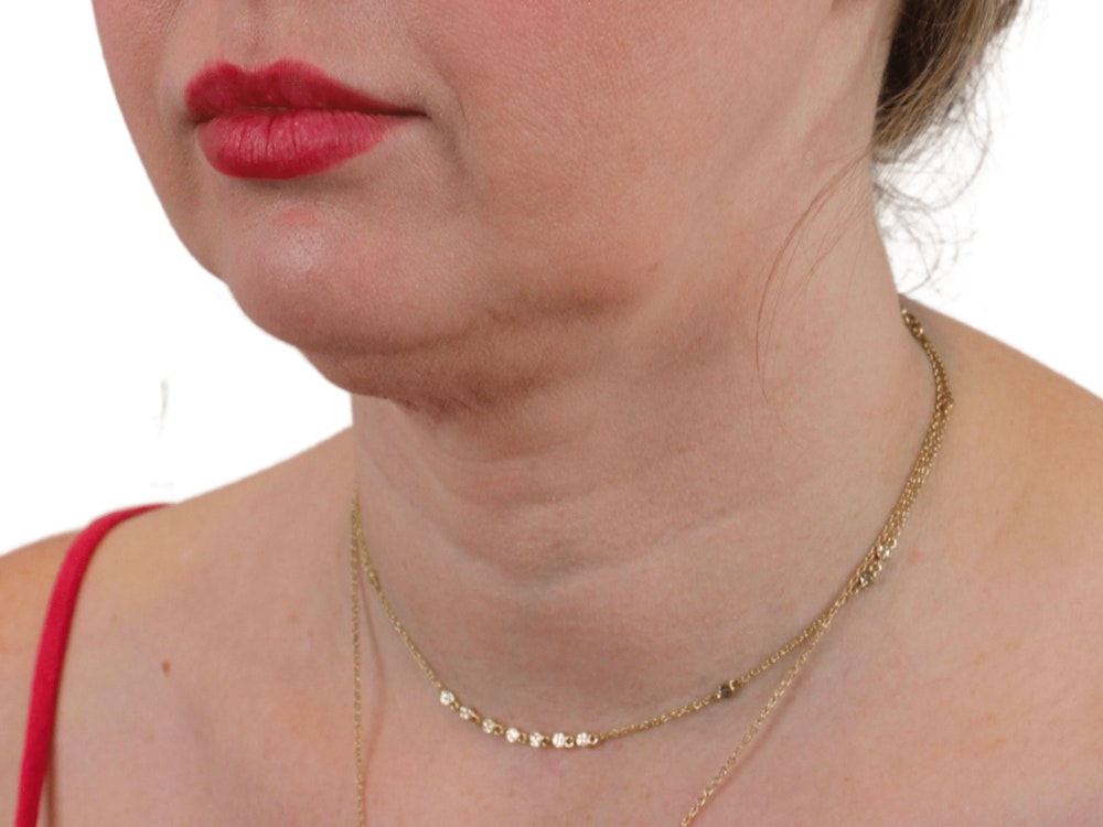 Deep Neck Lift Before & After Gallery - Patient 148352221 - Image 7