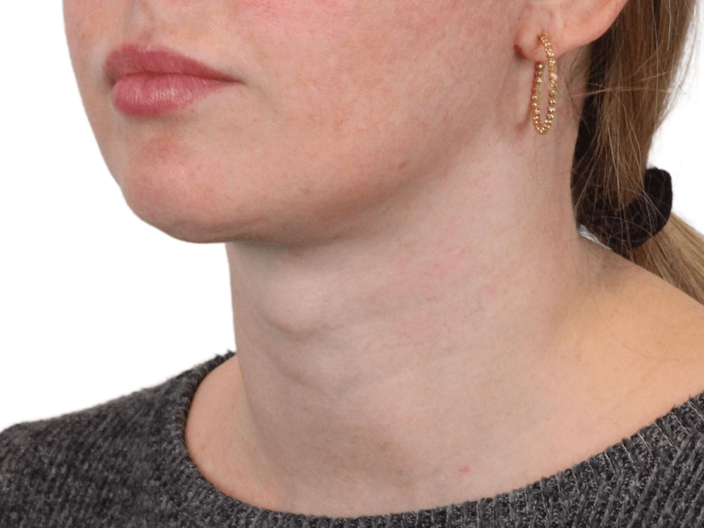 Deep Neck Lift Before & After Gallery - Patient 148352221 - Image 8