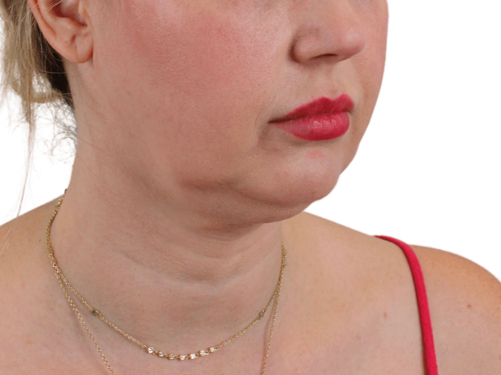 Deep Neck Lift Before & After Gallery - Patient 148352221 - Image 9