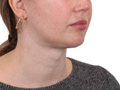 Deep Neck Lift Before & After Gallery - Patient 148352221 - Image 10