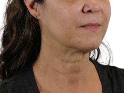 Deep Neck Lift Before & After Gallery - Patient 113523041 - Image 1