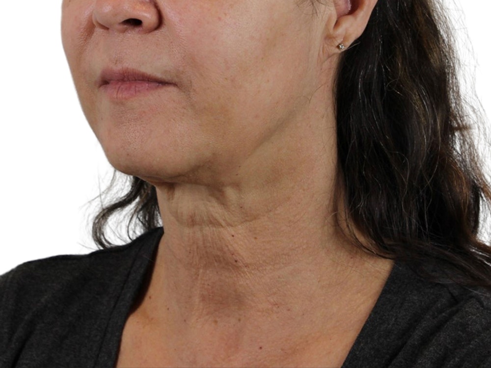 Deep Neck Lift Before & After Gallery - Patient 113523041 - Image 3
