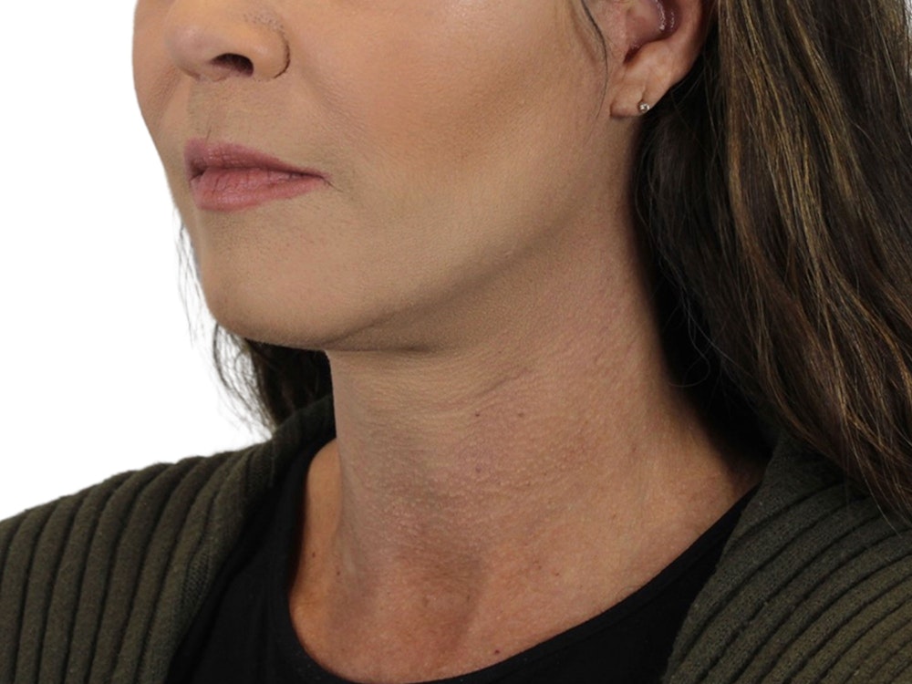 Deep Neck Lift Before & After Gallery - Patient 113523041 - Image 4