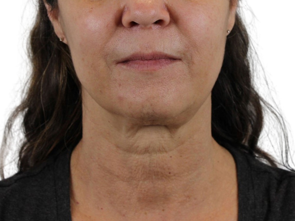 Deep Neck Lift Before & After Gallery - Patient 113523041 - Image 5