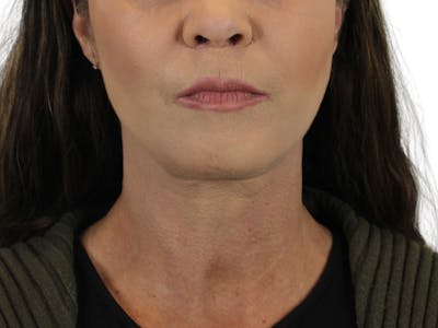 Deep Neck Lift Before & After Gallery - Patient 113523041 - Image 6