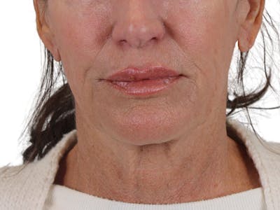 Deep Neck Lift Before & After Gallery - Patient 121845161 - Image 1
