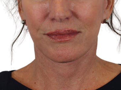 Deep Neck Lift Before & After Gallery - Patient 121845161 - Image 2