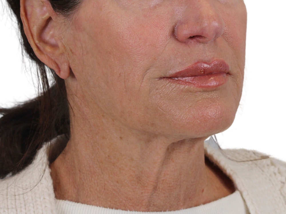 Deep Neck Lift Before & After Gallery - Patient 121845161 - Image 3