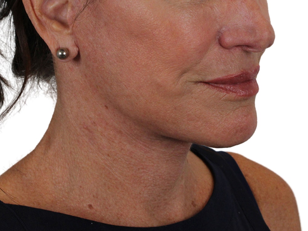 Deep Neck Lift Before & After Gallery - Patient 121845161 - Image 4
