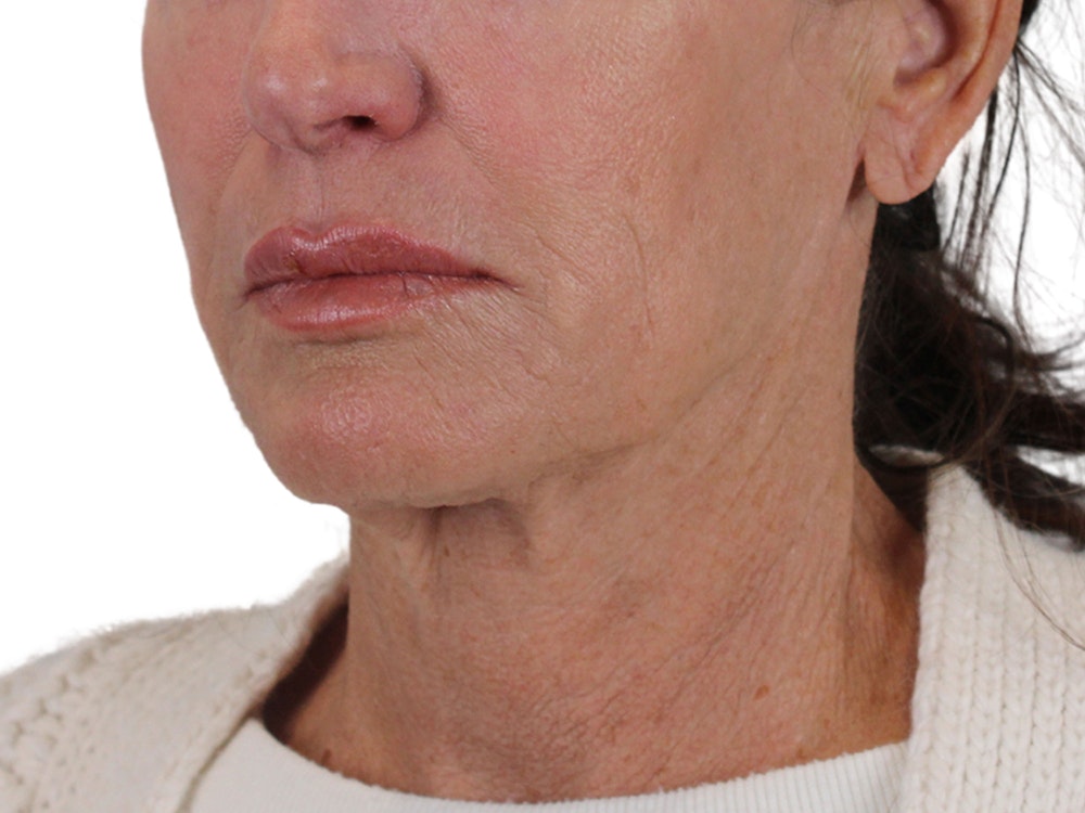 Deep Neck Lift Before & After Gallery - Patient 121845161 - Image 5