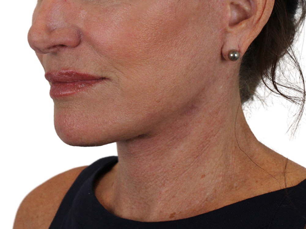 Deep Neck Lift Before & After Gallery - Patient 121845161 - Image 6