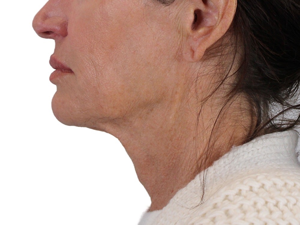 Deep Neck Lift Before & After Gallery - Patient 121845161 - Image 7