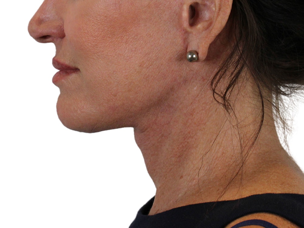 Deep Neck Lift Before & After Gallery - Patient 121845161 - Image 8