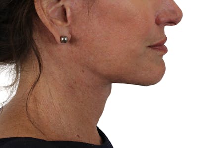 Deep Neck Lift Before & After Gallery - Patient 121845161 - Image 10