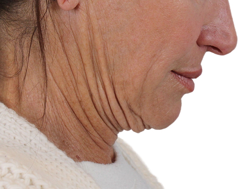 Deep Neck Lift Before & After Gallery - Patient 121845161 - Image 11