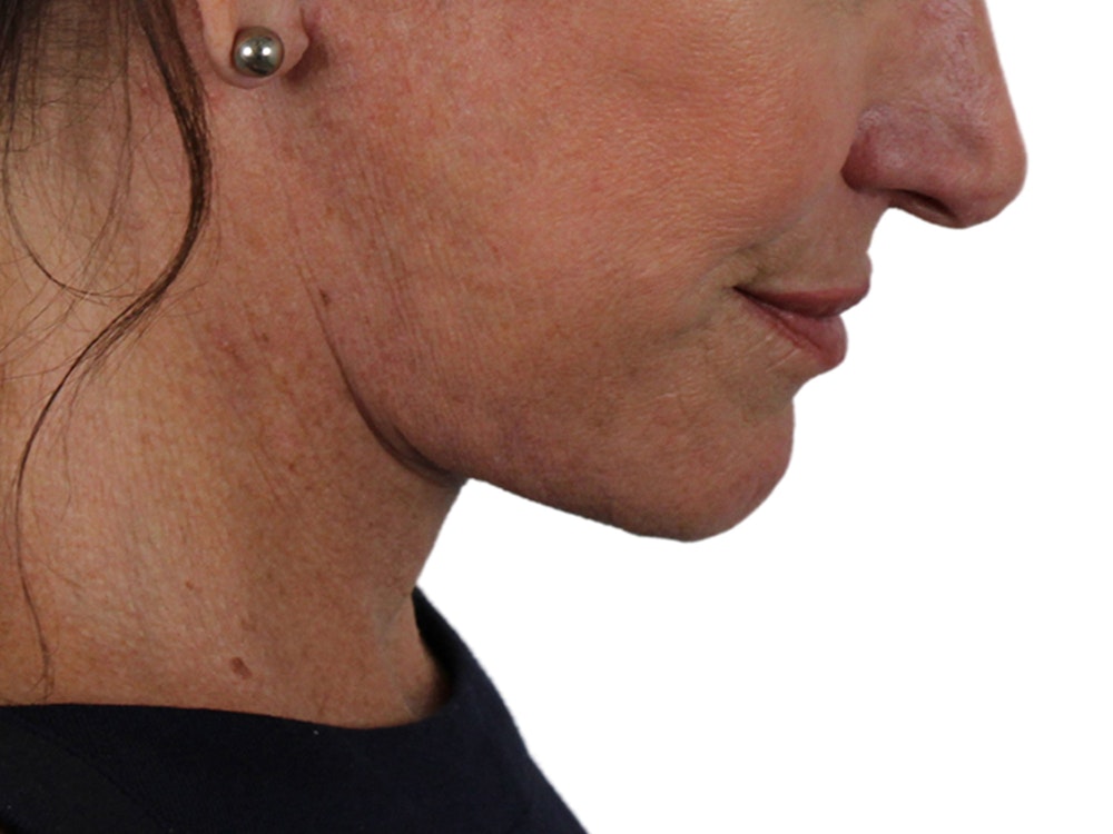 Deep Neck Lift Before & After Gallery - Patient 121845161 - Image 12
