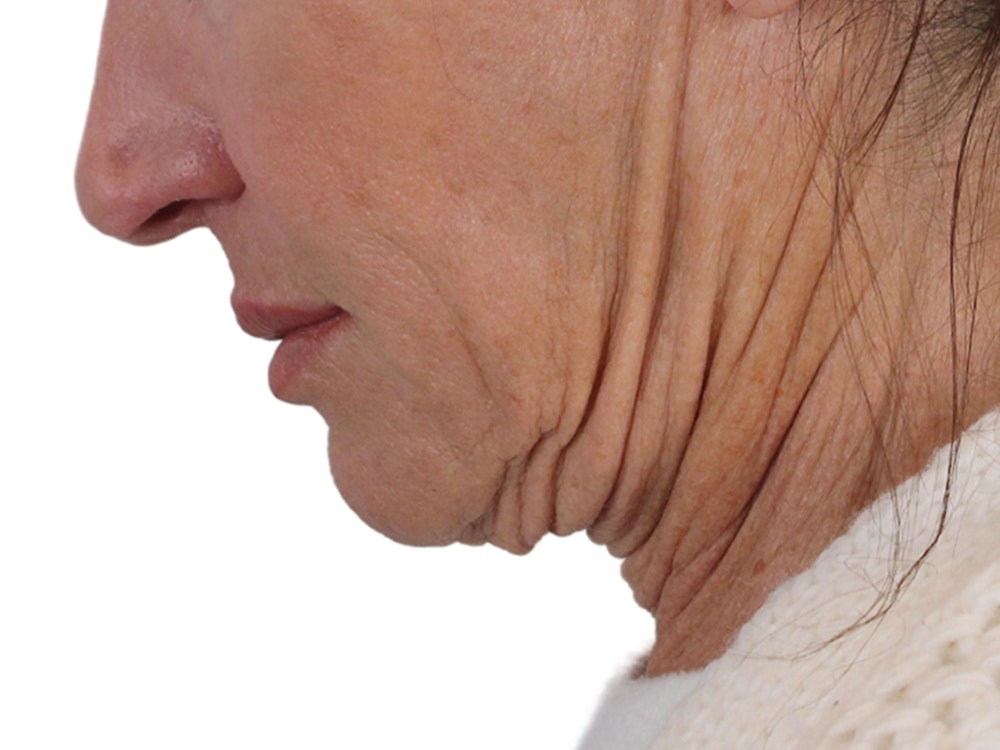 Deep Neck Lift Before & After Gallery - Patient 121845161 - Image 13