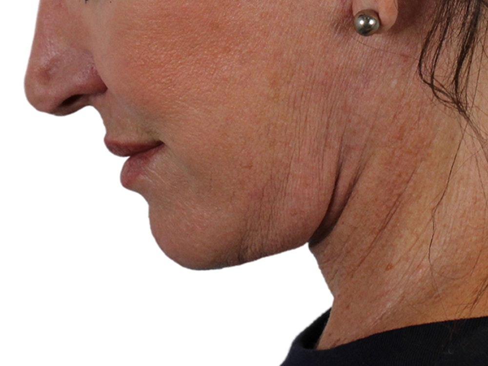 Deep Neck Lift Before & After Gallery - Patient 121845161 - Image 14