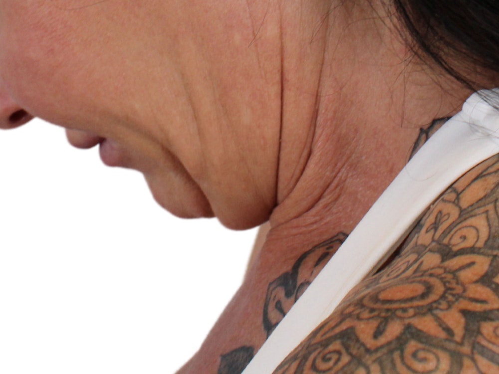Deep Neck Lift Before & After Gallery - Patient 122751157 - Image 7