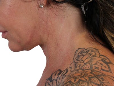 Deep Neck Lift Before & After Gallery - Patient 122751157 - Image 8