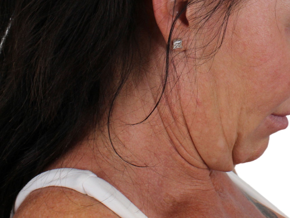 Deep Neck Lift Before & After Gallery - Patient 122751157 - Image 13