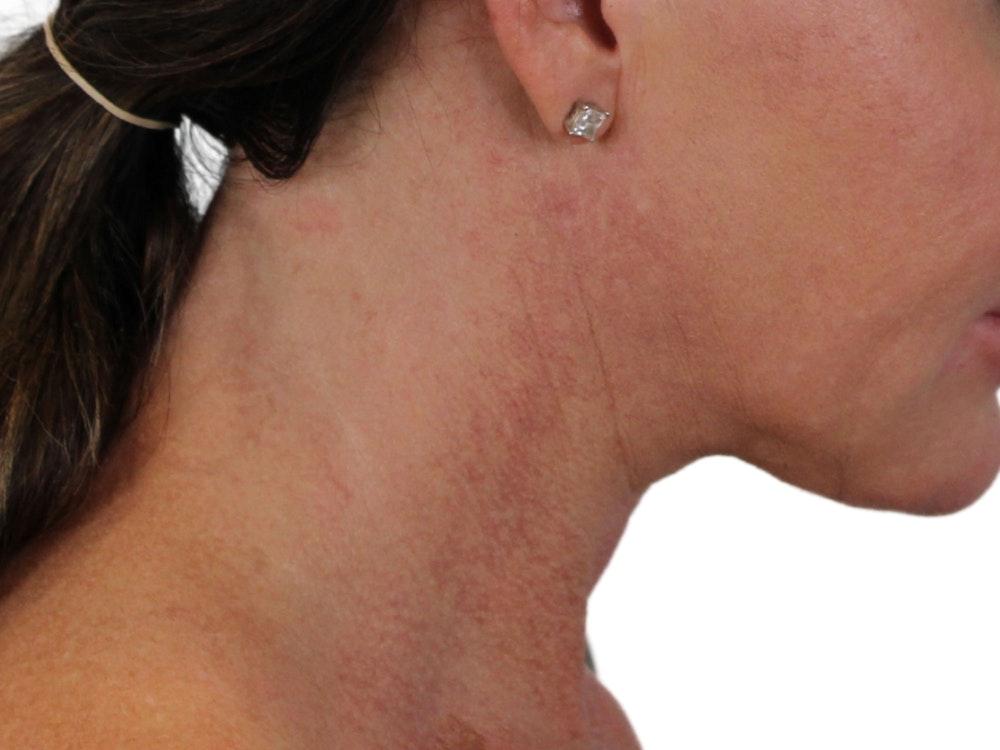 Deep Neck Lift Before & After Gallery - Patient 122751157 - Image 14