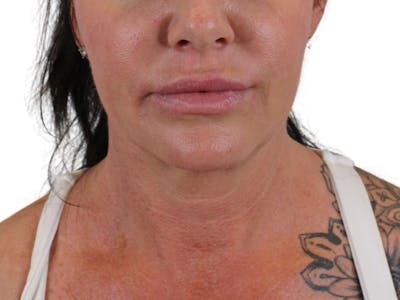 Deep Neck Lift Before & After Gallery - Patient 122751157 - Image 1