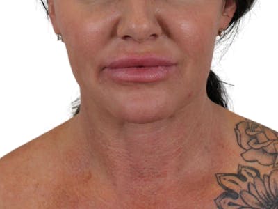 Deep Neck Lift Before & After Gallery - Patient 122751157 - Image 2