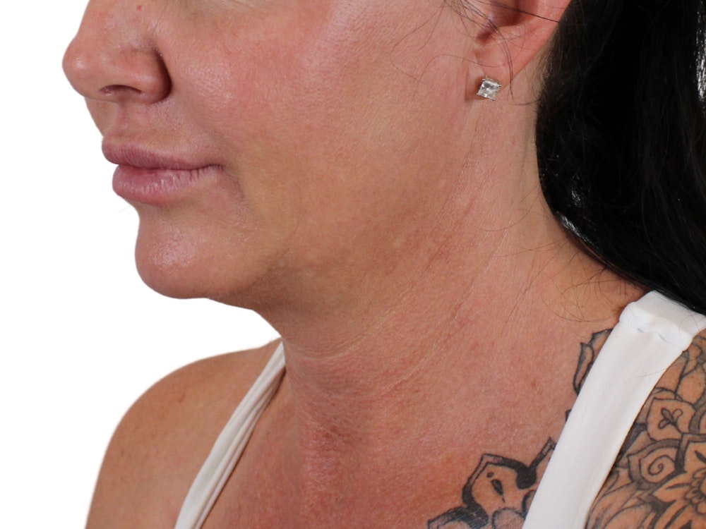 Deep Neck Lift Before & After Gallery - Patient 122751157 - Image 3