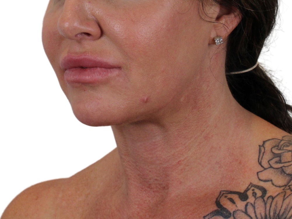 Deep Neck Lift Before & After Gallery - Patient 122751157 - Image 4