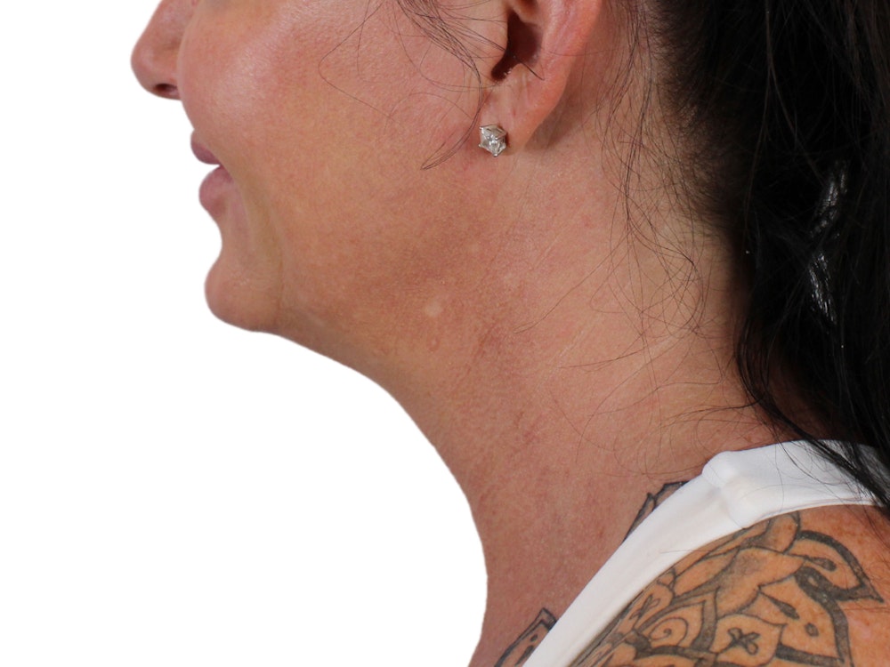 Deep Neck Lift Before & After Gallery - Patient 122751157 - Image 5