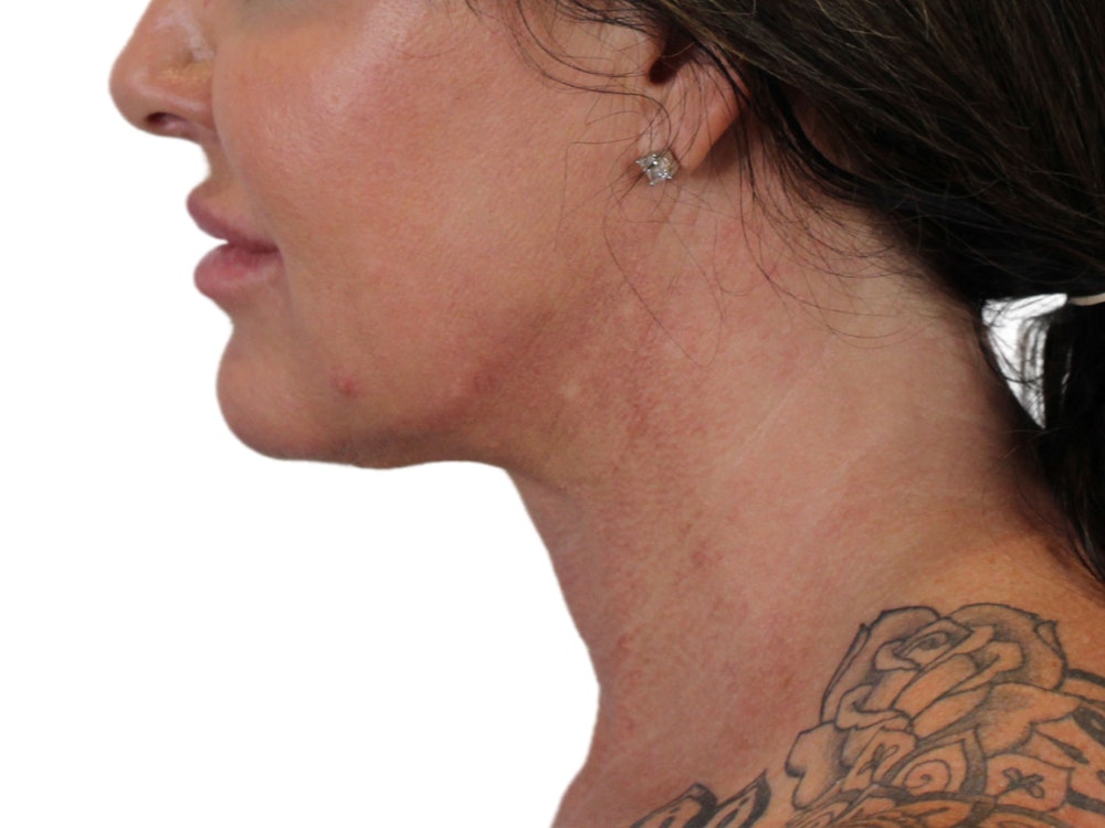 Deep Neck Lift Before & After Gallery - Patient 122751157 - Image 6