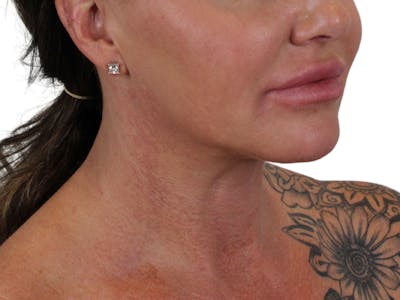Deep Neck Lift Before & After Gallery - Patient 122751157 - Image 10