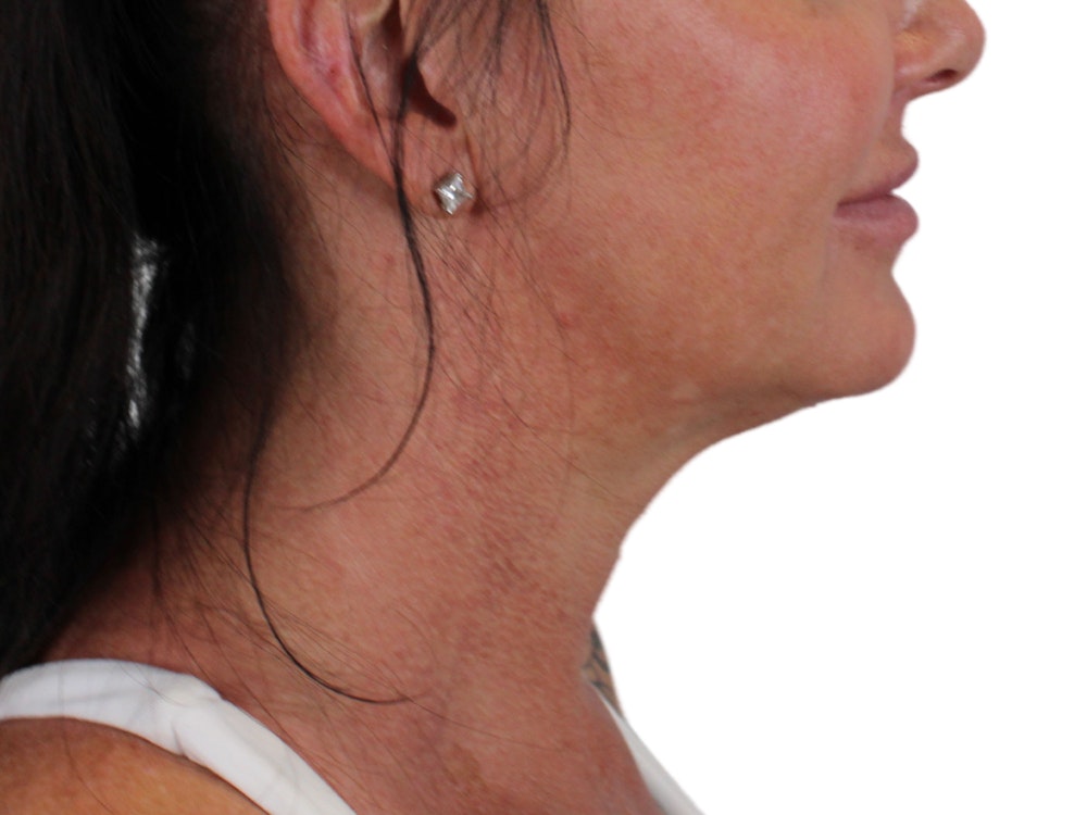 Deep Neck Lift Before & After Gallery - Patient 122751157 - Image 11