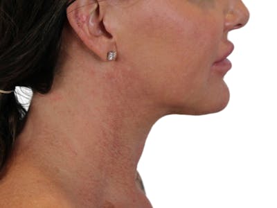 Deep Neck Lift Before & After Gallery - Patient 122751157 - Image 12