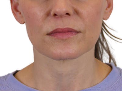 Deep Neck Lift Before & After Gallery - Patient 122751194 - Image 1