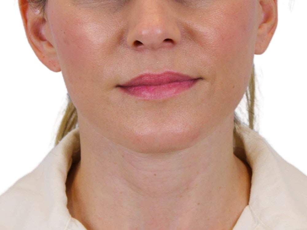 Deep Neck Lift Before & After Gallery - Patient 122751194 - Image 2